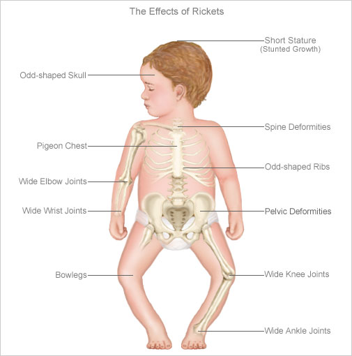 symptoms-of-deficiency-rickets